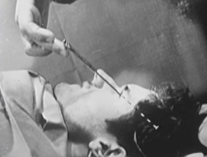 Photograph of a man being lobotomized