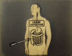 Photograph of a man, with a diagram of a large intestine superimposed